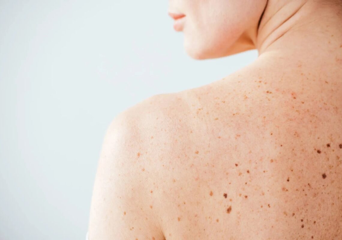 3-melanoma-pelle-neo-marina-conese-dermatologa