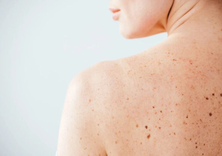 3-melanoma-pelle-neo-marina-conese-dermatologa