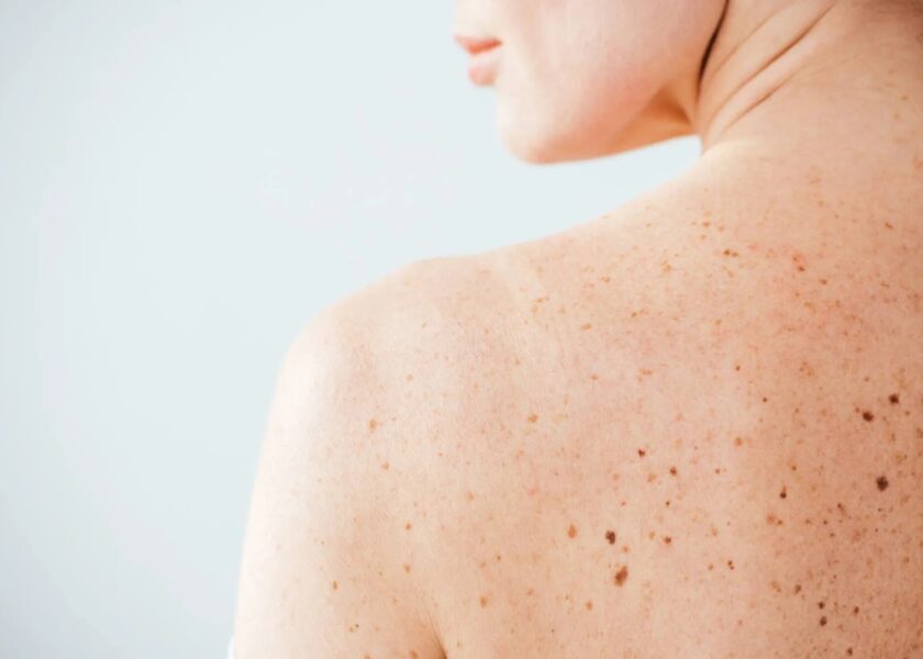 3-melanoma-pelle-neo-marina-conese-dermatologa