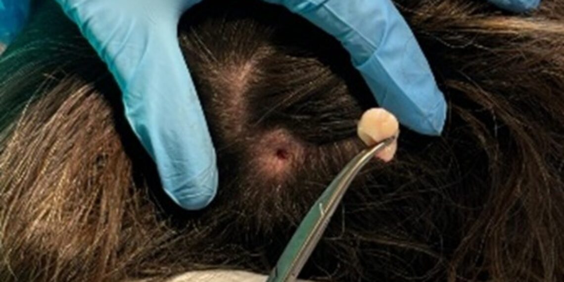 Chirurgia dermatologica con tecnica minimamente invasiva