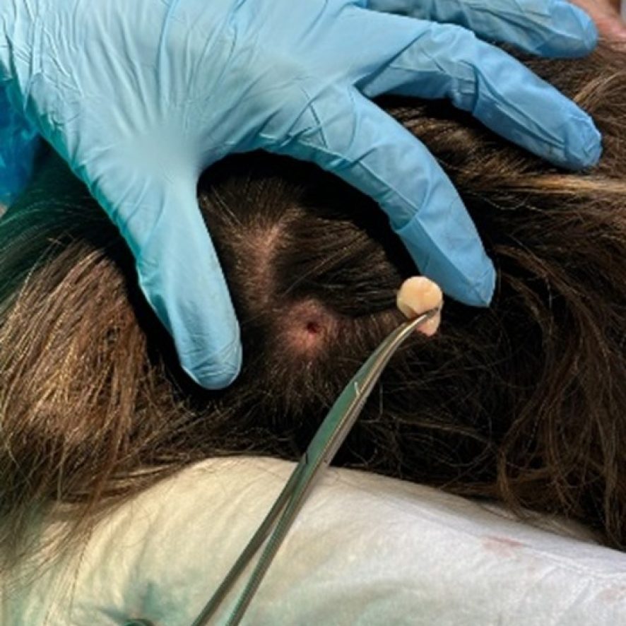 Chirurgia dermatologica con tecnica minimamente invasiva