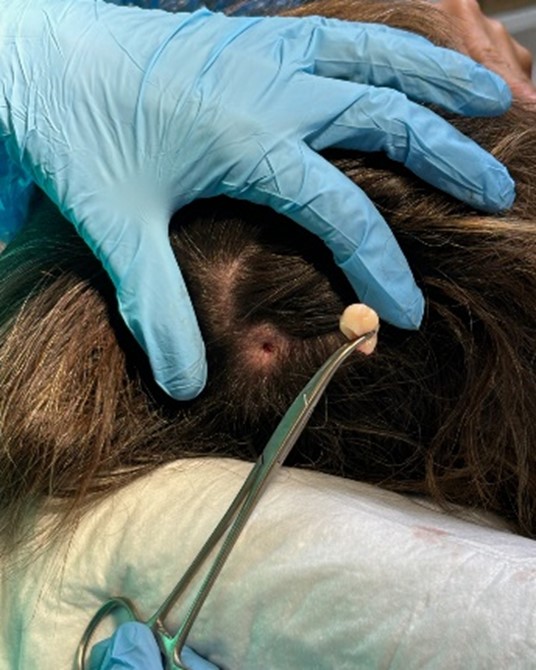 Chirurgia dermatologica con tecnica minimamente invasiva
