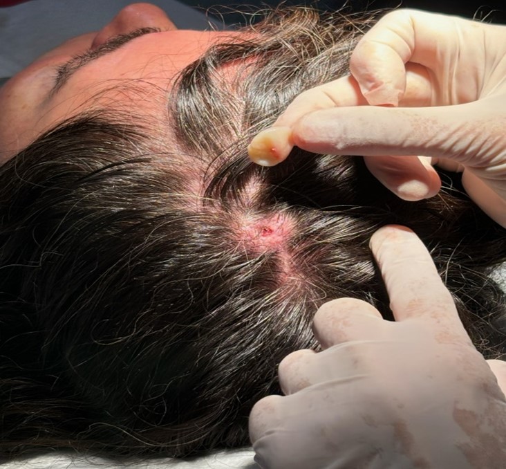 Rimozione cisti sebacee caso clinico risolto