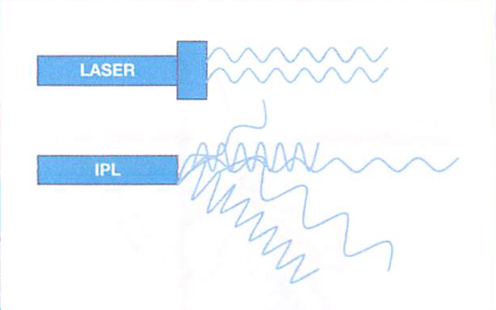 Modalità d’emissione della luce Laser o IPL