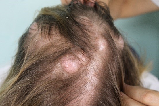 RIMOZIONE DI CISTI SEBACEE
