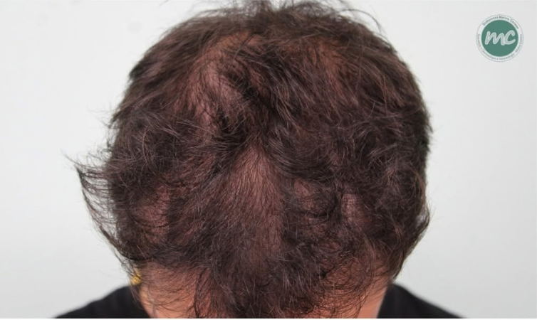alopecia-uomo-dottoressa-conese