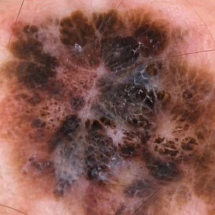 nei-nevi-melanoma