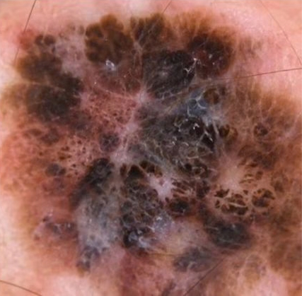nei-nevi-melanoma
