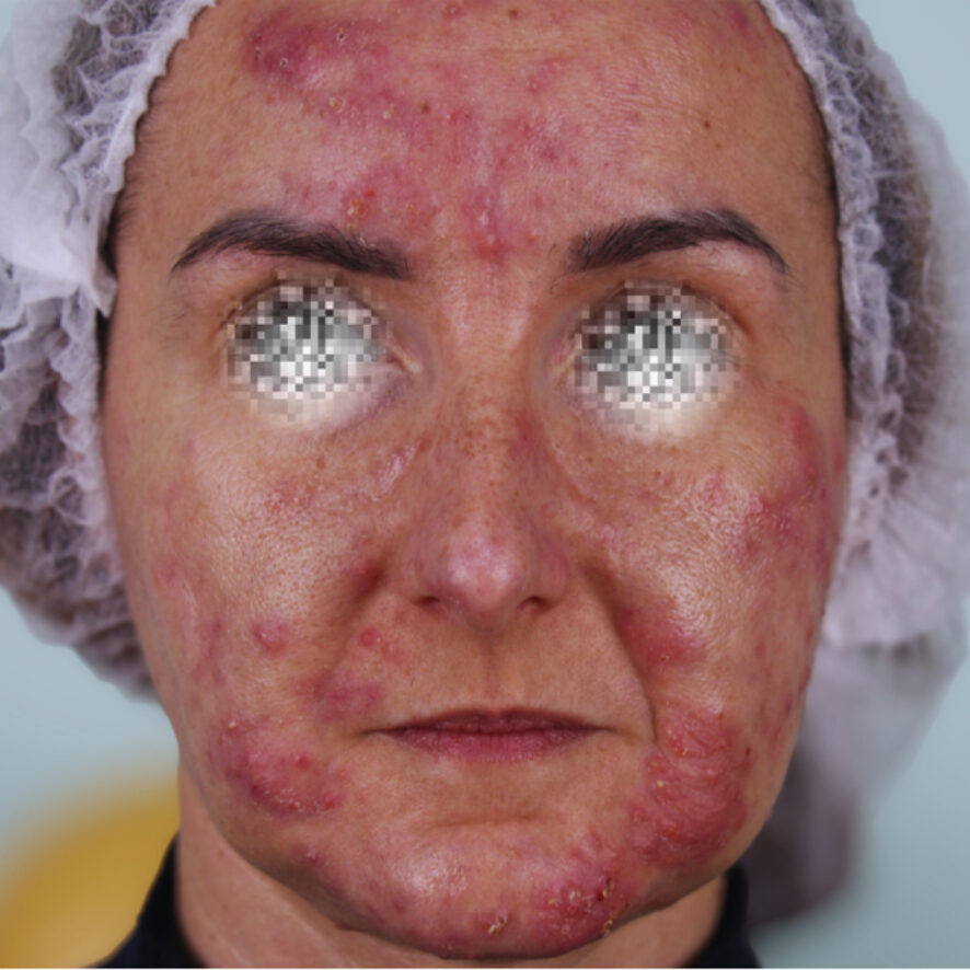 percorso-acne-1-prima