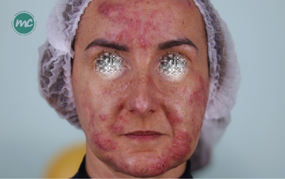 percorso-acne-1-prima