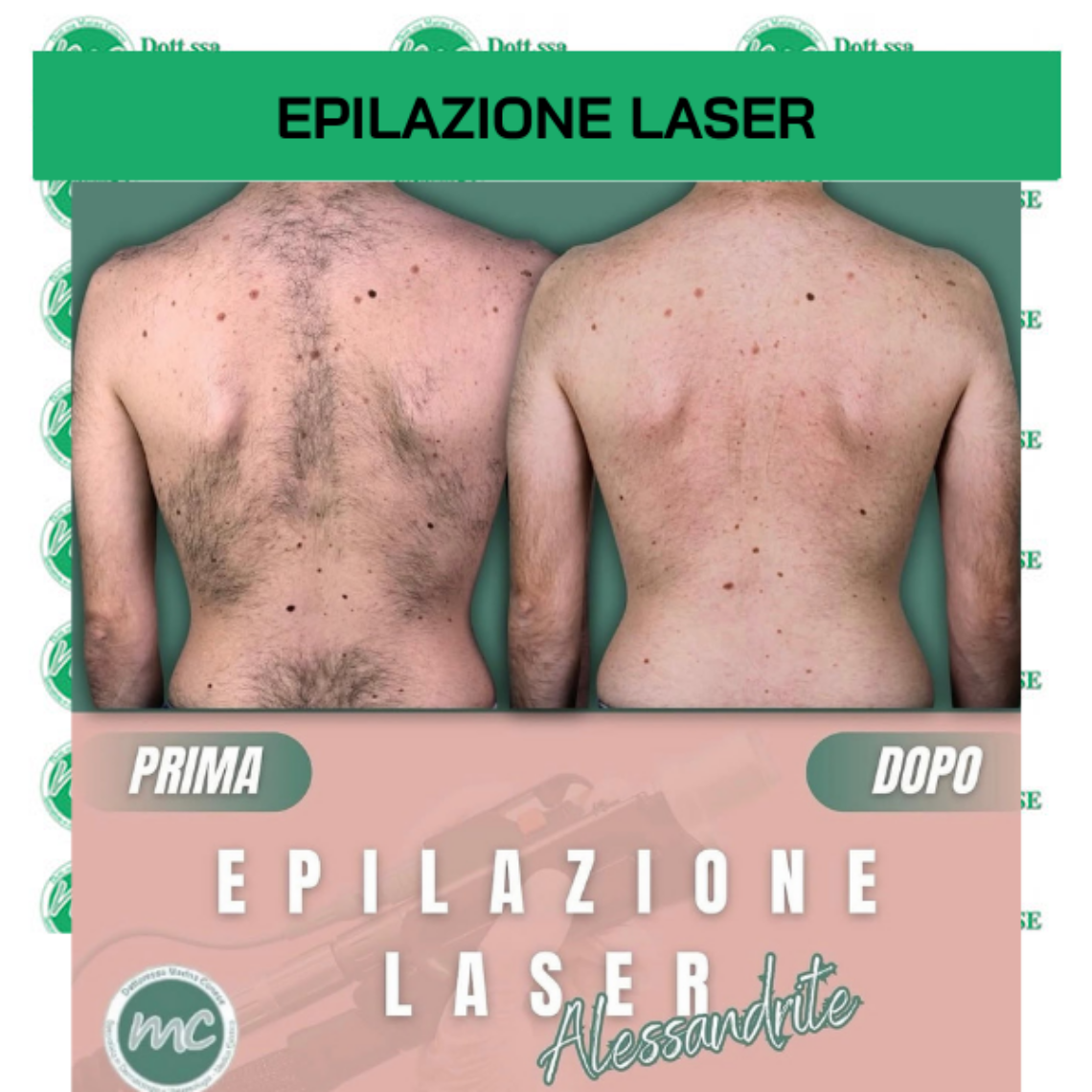 Epilazione Laser Alessandrite
