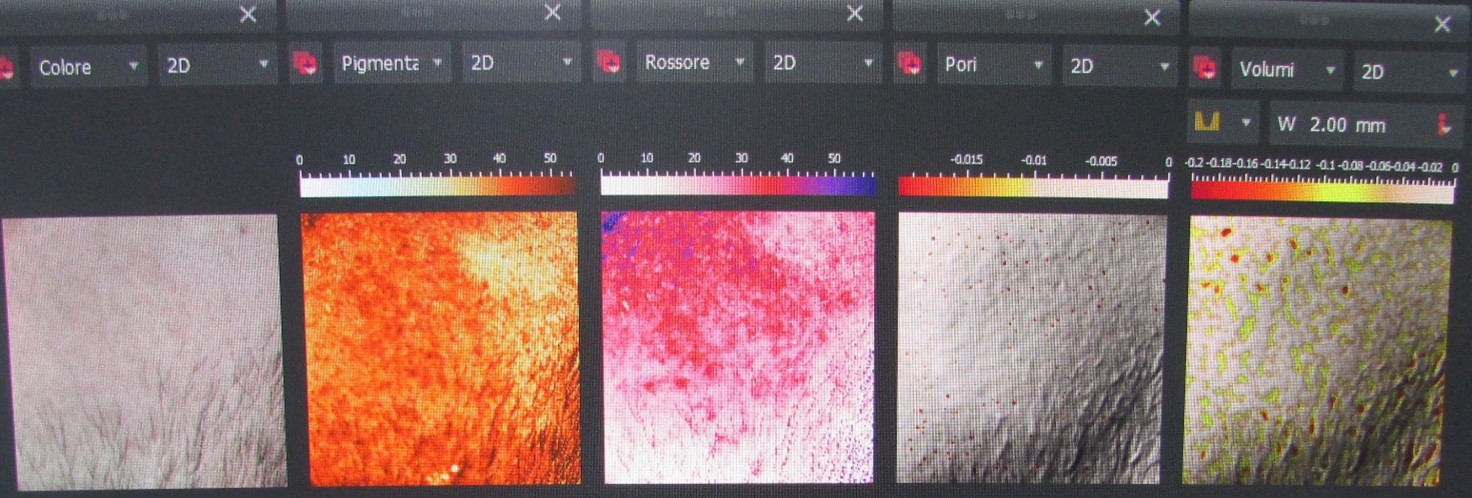 ANALISI MULTISPETTRALE - PERCORSO ACNE