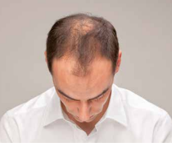 alopecia-androgenetica