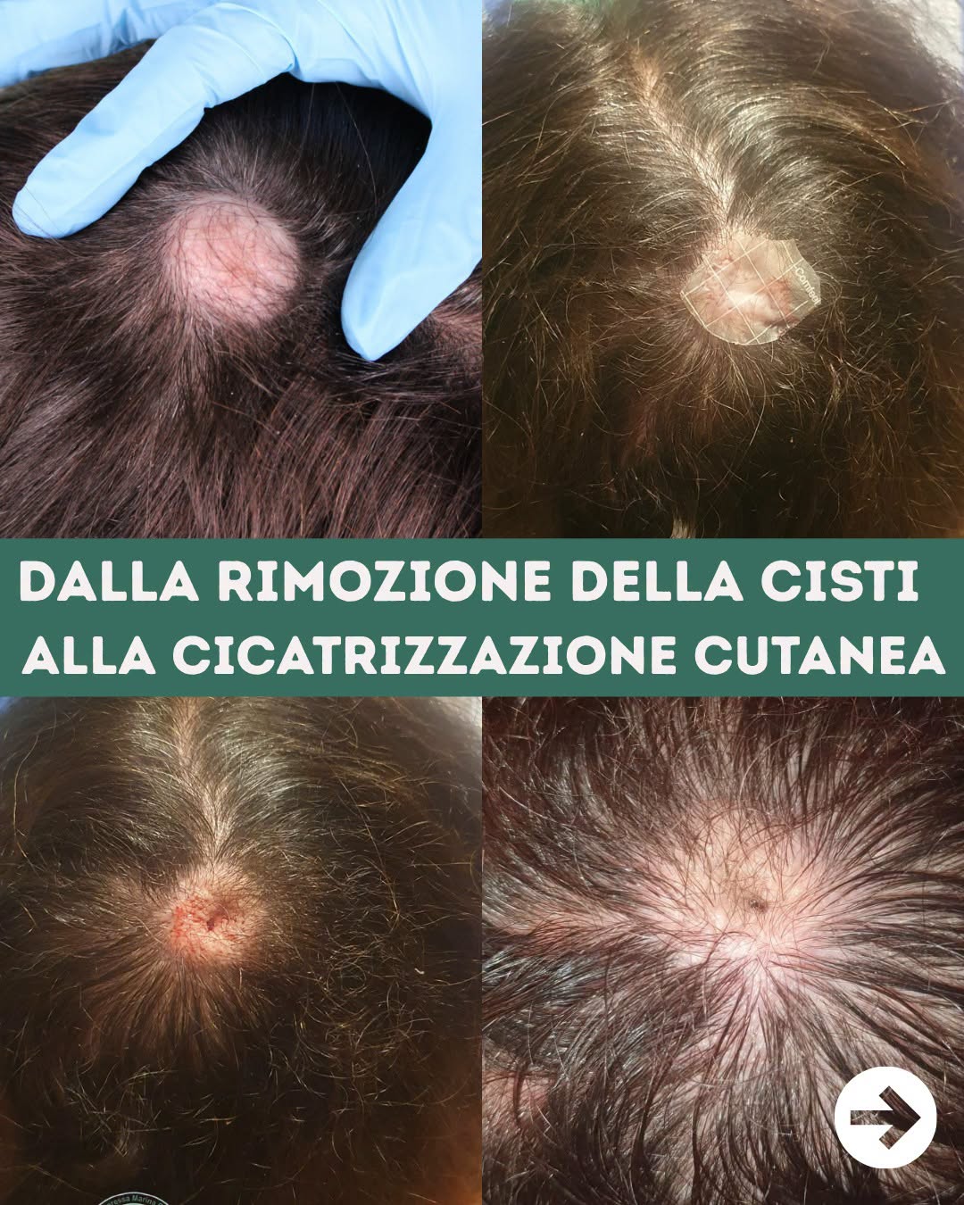 Rimozione Cisti sebacee