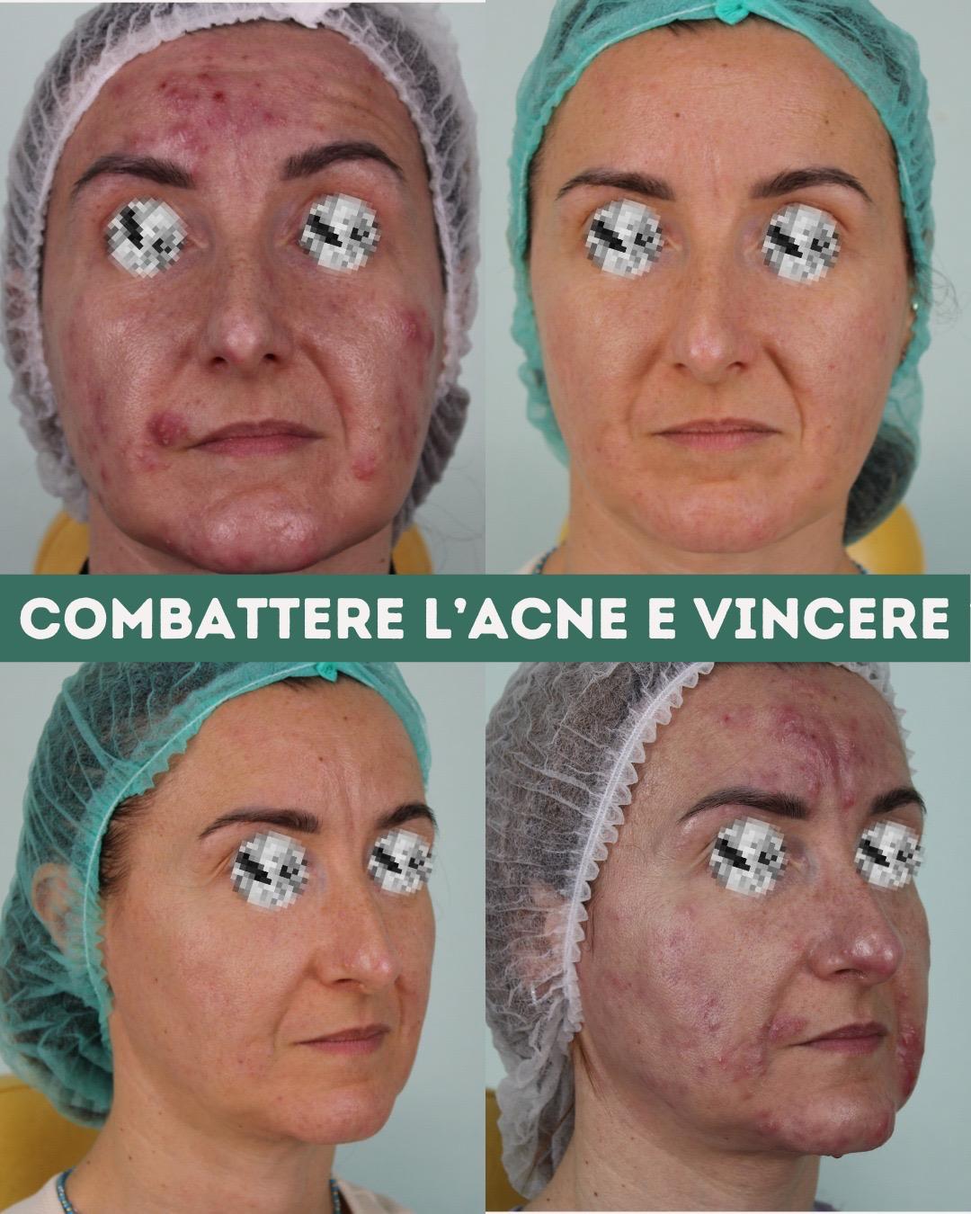 Trattamento acne grave con successo a bari - Dott.ssa Marina Conese