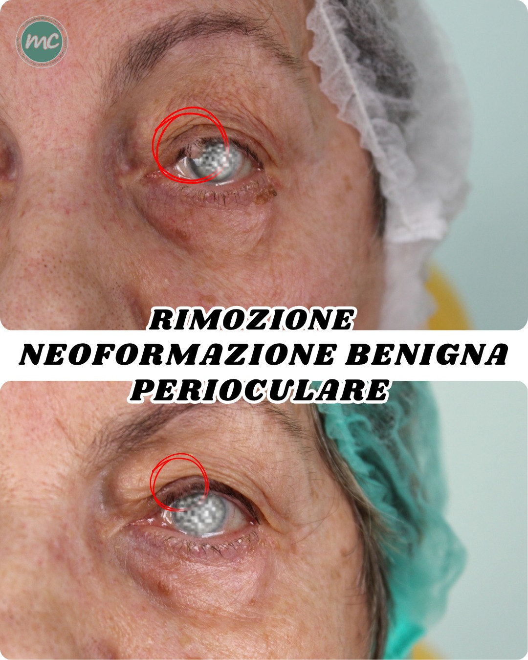 rimozione-cisti-zona-critica-conese
