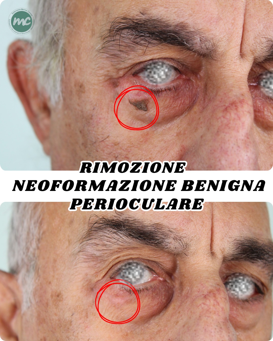 rimozione-cisti-zona-perioculare
