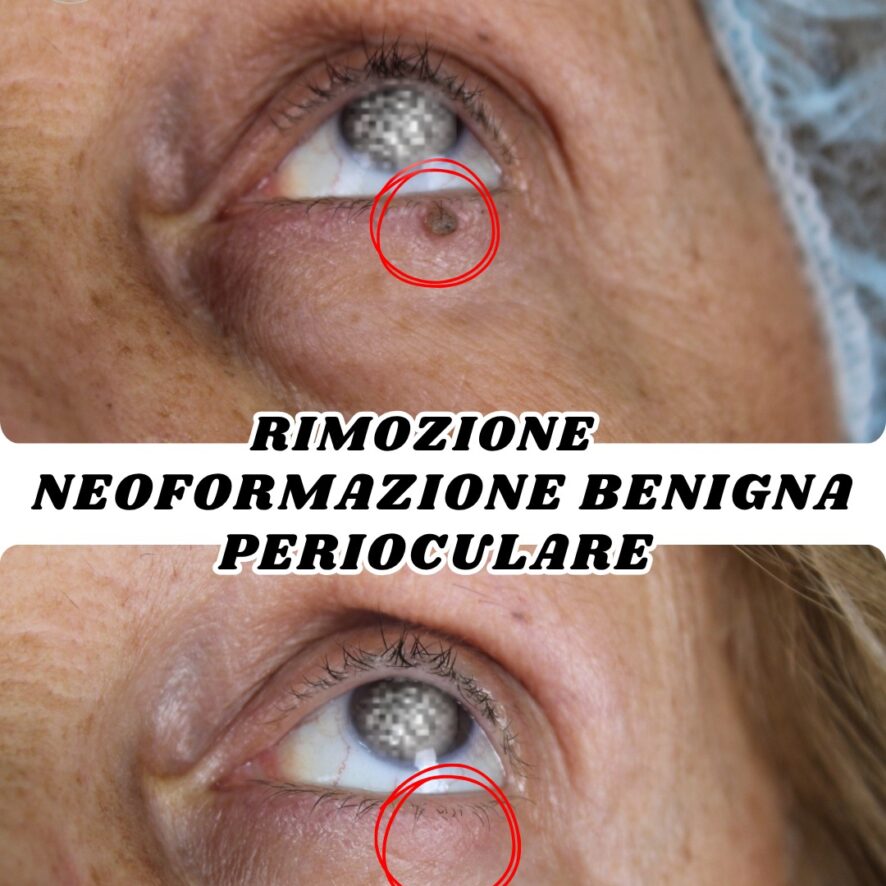rimozione-cisti-zona-perioculare