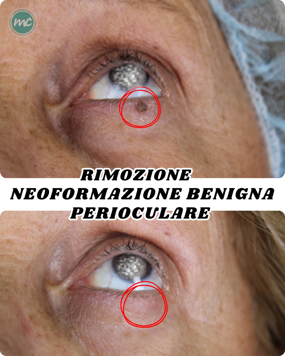 rimozione-cisti-zona-perioculare