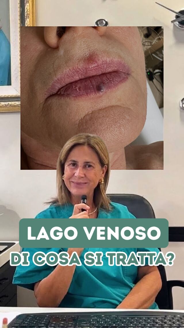 Il CASO CLINICO dell'altro giorno: DI COSA SI TRATTA ❓

Il LAGO VENOSO è una lesione vascolare benigna e non pericolosa, che si presenta generalmente come una piccola macchia o papula morbida al tatto. Di colore blu-violaceo, compare soprattutto sulle labbra ma anche su altre zone esposte al sole.

Tutti i dettagli e come rimuovo questa lesione nel mio Studio li trovate nel reel 👀

📍Via Raffaele De Cesare 15, Bari
📞 𝟥𝟩𝟨 𝟣𝟣𝟧𝟣𝟪𝟤𝟨 (acne) / 𝟥𝟦𝟪 𝟨𝟣𝟢𝟥𝟦𝟨𝟣
☎️ 𝟢𝟪𝟢 𝟩𝟫𝟨𝟥𝟥𝟦𝟫

#dottssamarinaconese #dermatologia #medicinaestetica #bari #puglia #influencer #new