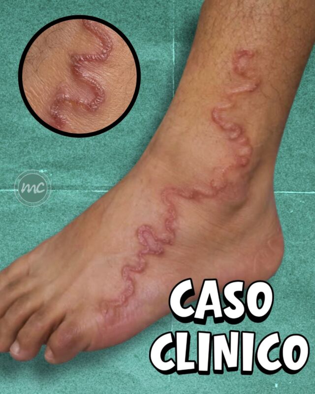 Ragazzi e ragazze, guardate qua ! 👀

Una striscia serpiginosa, dall’andamento tortuoso ed intensamente pruriginosa. Con un bordo che avanza progressivamente. 
Rappresenta un segno caratteristico di questa condizione molto particolare...

Un Caso Clinico NON mio, ma preso come esempio di patologia da LinkedIn.

Una manifestazione cutanea così particolare:
Secondo voi cosa potrebbe essere❓

📍Via Raffaele De Cesare 15, Bari
📞 𝟥𝟩𝟨 𝟣𝟣𝟧𝟣𝟪𝟤𝟨 (acne) / 𝟥𝟦𝟪 𝟨𝟣𝟢𝟥𝟦𝟨𝟣
☎️ 𝟢𝟪𝟢 𝟩𝟫𝟨𝟥𝟥𝟦𝟫

#dottssamarinaconese #dermatologia #medicinaestetica #bari #puglia #influencer #new