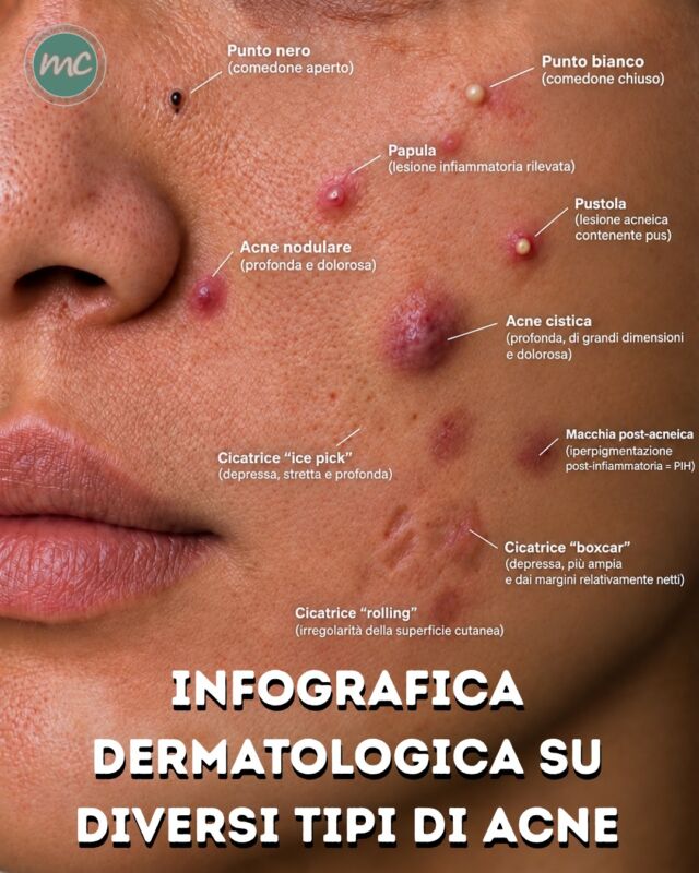 NON ESISTE UN SOLO TIPO DI ACNE E NON ESISTE UN UNICO APPROCCIO PER COMBATTERLA. 

Come potete vedere da questa infografica ci sono :

 - le papule e le pustole che sono delle lesioni attive dell'acne, quindi manifestazioni dell'acne in corso
- i  comedoni (punti neri e punti bianchi), anch'essi lesioni acneiche ma non infiammatorie
- l'acne nodulare e l'acne cistica, che sono forme più profonde e infiammatorie
- le macchie post-acne, cioè delle alterazioni del colore della pelle che possono rimanere dopo la risoluzione della problematica stessa
- ed infine le cicatrici d'acne, che sono invece esiti permanenti o duraturi della precedente infiammazione acneica e possono essere tra le altre, cicatrici ice-pick, a boxcar e rolling... 

Il mio obiettivo è sempre quello di approcciarsi alla problematica del paziente con un Percorso ACNE mirato e personalizzato, scegliendo di volta in volta i trattamenti e le terapie da eseguire in base al tipo di manifestazione, alla sua intensità ed alle caratteristiche del biotipo cutaneo del paziente. 

Con costanza, pazienza e tanta forza di volontà, come ho spesso condiviso qui sui miei canali social, i risultati arrivano. 🫶

PROCEDURE TERAPEUTICHE INNOVATIVE PERCORSO ACNE E RIMOZIONE CISTI SEBACEE DOTT.SSA MARINA CONESE™️

📍Via Raffaele De Cesare 15, Bari
📞 𝟥𝟩𝟨 𝟣𝟣𝟧𝟣𝟪𝟤𝟨 (acne) / 𝟥𝟦𝟪 𝟨𝟣𝟢𝟥𝟦𝟨𝟣
☎️ 𝟢𝟪𝟢 𝟩𝟫𝟨𝟥𝟥𝟦𝟫

#dottssamarinaconese #dermatologia #new #skin #bari #puglia #influencer
