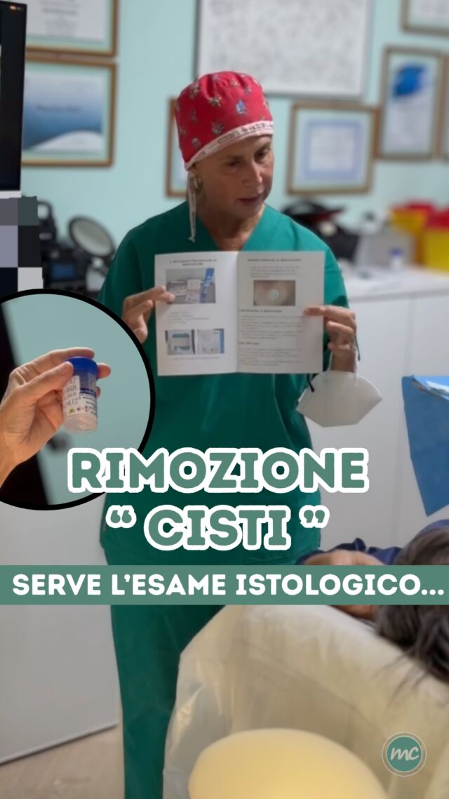 Concludiamo la settimana con la seconda RIMOZIONE CISTI per questa signora giunta da Torino appositamente per rimuoverle presso il mio Studio. 💪

In realtà come per la prima, anche qui si trattava NON di cisti ma molto probabilmente di un EPITELIOMA CALCIFICO di MALHERBE (pilomatricoma), cioè una formazione benigna che può presentarsi come un nodulo duro sotto la pelle.

In questi casi è necessario inviare il materiale asportato per l’esame istologico, l’unico modo per confermare con sicurezza la diagnosi di pilomatricoma.

PROCEDURE TERAPEUTICHE INNOVATIVE PERCORSO ACNE E RIMOZIONE CISTI SEBACEE DOTT.SSA MARINA CONESE™️

📍Via Raffaele De Cesare 15, Bari
📞 𝟥𝟩𝟨 𝟣𝟣𝟧𝟣𝟪𝟤𝟨 (acne) / 𝟥𝟦𝟪 𝟨𝟣𝟢𝟥𝟦𝟨𝟣
☎️ 𝟢𝟪𝟢 𝟩𝟫𝟨𝟥𝟥𝟦𝟫

#dottssamarinaconese #dermatologia #new #cisti #influencer #bari #puglia