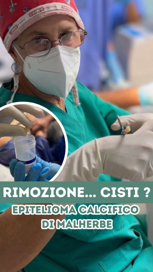 RIMOZIONE di quella che pensavo potesse essere una CISTI... per una signora proveniente dal Piemonte. 

Dopo averla attenzionata ecograficamente ho sospettato che si potesse trattare di un EPITELIOMA CALCIFICO di MALHERBE (pilomatricoma), cioè una formazione benigna che può presentarsi come un nodulo duro sotto la pelle e che può essere confusa con altre lesioni, tra cui una CISTI... 

In questi casi è necessario inviare il materiale asportato per l’esame istologico, l’unico modo per confermare con sicurezza la diagnosi. 🤔

PROCEDURE TERAPEUTICHE INNOVATIVE PERCORSO ACNE E RIMOZIONE CISTI SEBACEE DOTT.SSA MARINA CONESE™️

📍Via Raffaele De Cesare 15, Bari
📞 𝟥𝟩𝟨 𝟣𝟣𝟧𝟣𝟪𝟤𝟨 (acne) / 𝟥𝟦𝟪 𝟨𝟣𝟢𝟥𝟦𝟨𝟣
☎️ 𝟢𝟪𝟢 𝟩𝟫𝟨𝟥𝟥𝟦𝟫

#dottssamarinaconese #dermatologia #new #cisti #influencer #bari #puglia