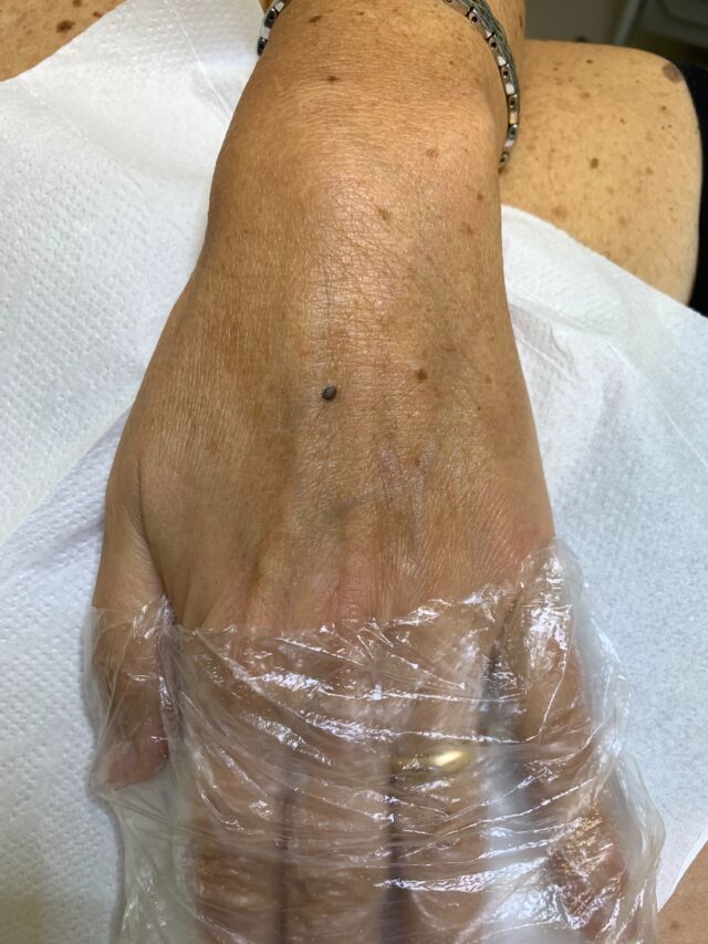 Clinica & Dermatoscopia di una lesione pigmentata sul dorso della mano. 
La diagnosi te la svelo e spiego in didascalia.

#dottssamarinaconese #new #dermatologia