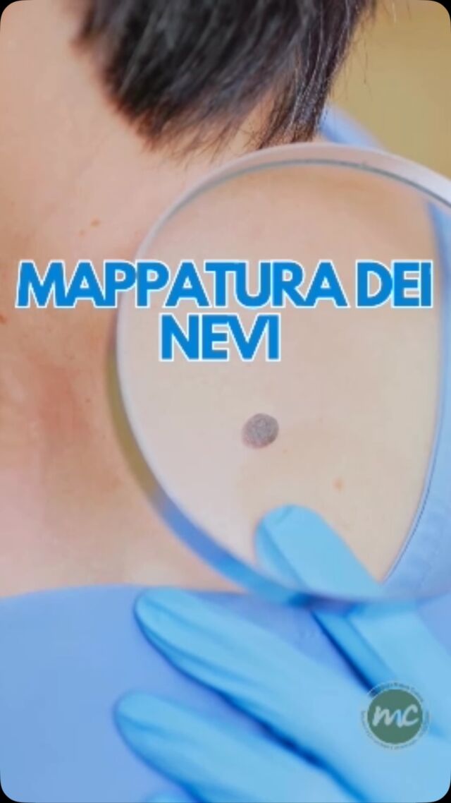 La mappatura dei nevi (o nei) è l'esame diagnostico fondamentale per la prevenzione secondaria del melanoma e degli altri tumori della pelle. Consente di monitorare l'evoluzione delle lesioni cutanee nel tempo e di intervenire tempestivamente in caso di trasformazioni atipiche.
Tutto il resto … nel Reel 🫵🏻🧐😉

📍Via Raffaele De Cesare 15, Bari
📞 𝟥𝟩𝟨 𝟣𝟣𝟧𝟣𝟪𝟤𝟨 (acne) / 𝟥𝟦𝟪 𝟨𝟣𝟢𝟥𝟦𝟨𝟣
☎️ 𝟢𝟪𝟢 𝟩𝟫𝟨𝟥𝟥𝟦𝟫

#dottssamarinaconese #dermatologia #new #nevi #prevenzione