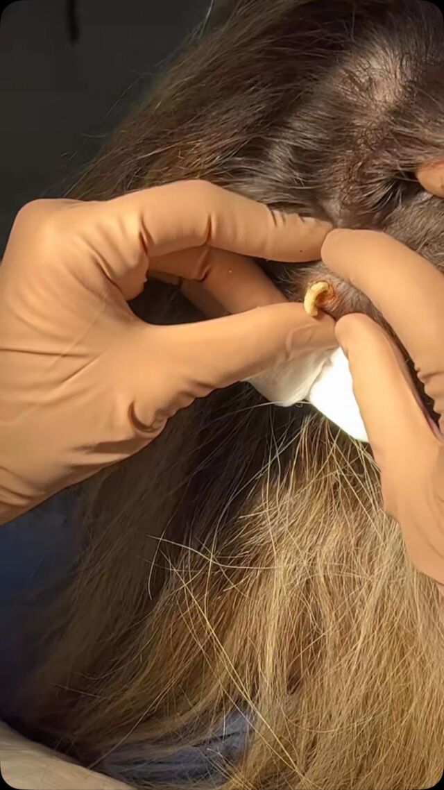 Rimozione completa di Cisti Sebacea del cuoio capelluto. 
Vi auguro una buona visione 👀

PROCEDURE TERAPEUTICHE INNOVATIVE PERCORSO ACNE E RIMOZIONE CISTI SEBACEE DOTT.SSA MARINA CONESE™️

📍Via Raffaele De Cesare 15, Bari
📞 𝟥𝟩𝟨 𝟣𝟣𝟧𝟣𝟪𝟤𝟨 (acne) / 𝟥𝟦𝟪 𝟨𝟣𝟢𝟥𝟦𝟨𝟣
☎️ 𝟢𝟪𝟢 𝟩𝟫𝟨𝟥𝟥𝟦𝟫

#dottssamarinaconese #new #cystremoval #dermatologia #influencer