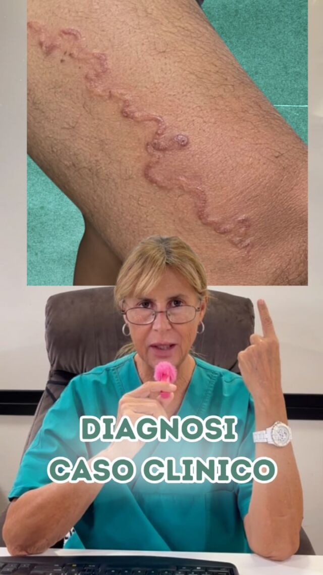 Buon lunedì e buon inizio settimana a tutti 😎

Vi ricordate il CASO CLINICO della scorsa settimana, che tanto vi aveva incuriosito? 

Ecco la DIAGNOSI : si trattava di una PARASSITOSI CUTANEA causata dalla LARVA MIGRANS. 
Un'infestazione provocata dalle larve di alcuni parassiti, che penetrano nella pelle e si spostano negli strati superficiali...

A cosa è dovuto ? Come si cura ?
Tutti i dettagli nel reel 🤔

📍Via Raffaele De Cesare 15, Bari
📞 𝟥𝟩𝟨 𝟣𝟣𝟧𝟣𝟪𝟤𝟨 (acne) / 𝟥𝟦𝟪 𝟨𝟣𝟢𝟥𝟦𝟨𝟣
☎️ 𝟢𝟪𝟢 𝟩𝟫𝟨𝟥𝟥𝟦𝟫

#dottssamarinaconese #dermatologia #medicinaestetica #bari #puglia #influencer #new