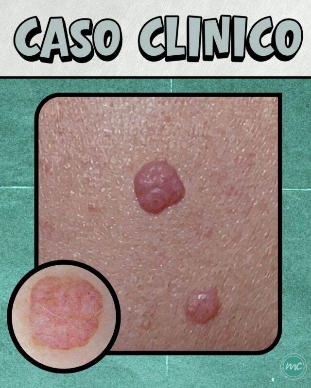 Un nuovo CASO CLINICO da condividere con voi ⚠️

DI COSA SI TRATTA❓
Il NEVO DERMICO (o nevo intradermico) è una forma comune e generalmente benigna di nevo melanocitario. 
Si presenta generalmente come una papula o un piccolo nodulo a cupola, dalla superficie liscia o talvolta papillomatoso, con una colorazione che può variare dal marrone chiaro al color carne. 

Può comparire in diverse aree del corpo, in particolare su viso e collo e in alcuni casi può presentare anche dei peli che emergono dalla superficie.

DERMATOSCOPIA 🔎 
Come potete notare dalla dermatoscopia, il nevo dermico presenta un pattern omogeneo color carne con la presenza di vasi a forma di virgola.

E' PERICOLOSO ❓
Trattandosi di una lesione generalmente benigna, NON è necessario rimuoverla, a meno che non provochi fastidio o si desideri eliminarla per motivi estetici.

📍Via Raffaele De Cesare 15, Bari
📱 𝟥𝟩𝟨 𝟣𝟣𝟧𝟣𝟪𝟤𝟨 (acne) / 𝟥𝟦𝟪 𝟨𝟣𝟢𝟥𝟦𝟨𝟣
☎️ 𝟢𝟪𝟢 𝟩𝟫𝟨𝟥𝟥𝟦𝟫

#dottssamarinaconese #dermatologia #casoclinico #new #influencer #bari