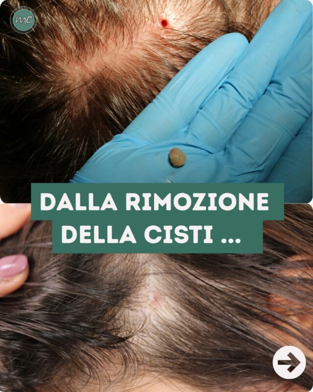 Spesso mi chiedete: 
"Ma cosa succede dopo la RIMOZIONE di una CISTI SEBACEA del CUOIO CAPELLUTO❓"

Queste immagini mostrano proprio l'evoluzione della zona trattata:
 dall'immediato post rimozione della CISTI fino ai mesi successivi, quando il "forellino" risulta progressivamente meno visibile.

Subito dopo la rimozione nella zona trattata può rimanere un piccolo "forellino", che viene immediatamente coperto con una membrana di idrocolloide.

Cosa succede nei mesi successivi❓
Come potete vedere, quel piccolo foro tende progressivamente a restringersi: 
già nelle settimane successive l'apertura diventa sempre meno evidente e con il passare dei giorni la cute continua il suo naturale processo di guarigione.

PROCEDURE TERAPEUTICHE INNOVATIVE, PERCORSO ACNE E RIMOZIONE CISTI SEBACEE
DOTT.SSA MARINA CONESE™

📍 Via Raffaele De Cesare 15, Bari
📞 𝟥𝟩𝟨 𝟣𝟣𝟧𝟣𝟪𝟤𝟨 (acne) / 𝟥𝟦𝟪 𝟨𝟣𝟢𝟥𝟦𝟨𝟣
☎️ 𝟢𝟪𝟢 𝟩𝟫𝟨𝟥𝟥𝟦𝟫

#dottssamarinaconese #dermatologia #cisti #cistisebacea #cuoiocapelluto #bari #puglia