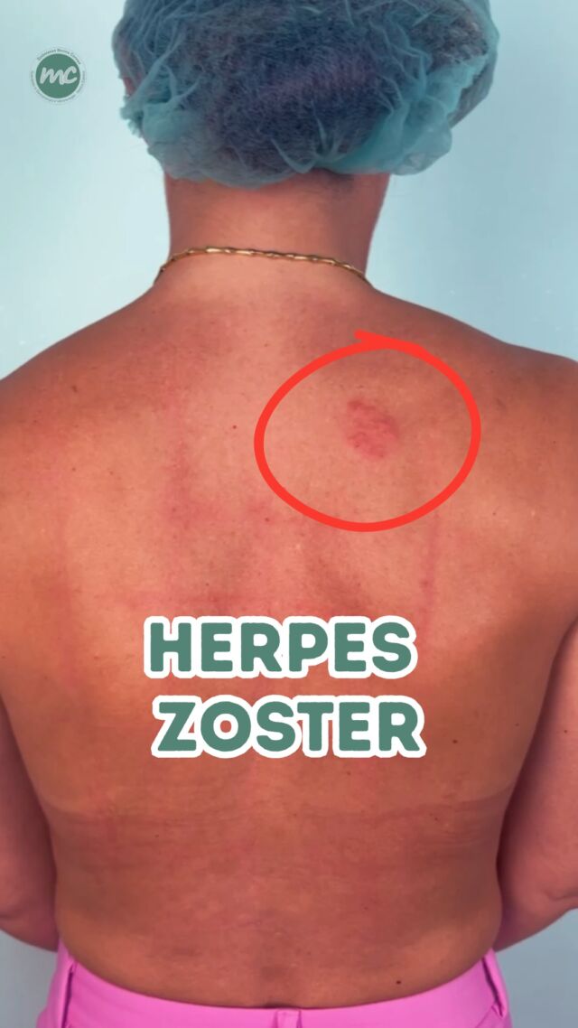 L’altro giorno durante un normale check-up cutaneo per il quale la paziente si era recata in studio, mi sono imbattuta in questa particolare lesione che aveva da 4, 5 giorni e le causava fastidio e dolore.

Si tratta di un HERPES ZOSTER, un’infezione causata dalla riattivazione del virus VZ... 🔎

📍Via Raffaele De Cesare 15, Bari
📱 𝟥𝟩𝟨 𝟣𝟣𝟧𝟣𝟪𝟤𝟨 (acne) / 𝟥𝟦𝟪 𝟨𝟣𝟢𝟥𝟦𝟨𝟣
☎️ 𝟢𝟪𝟢 𝟩𝟫𝟨𝟥𝟥𝟦𝟫

#dottssamarinaconese #dermatologia #casoclinico #new #influencer #bari