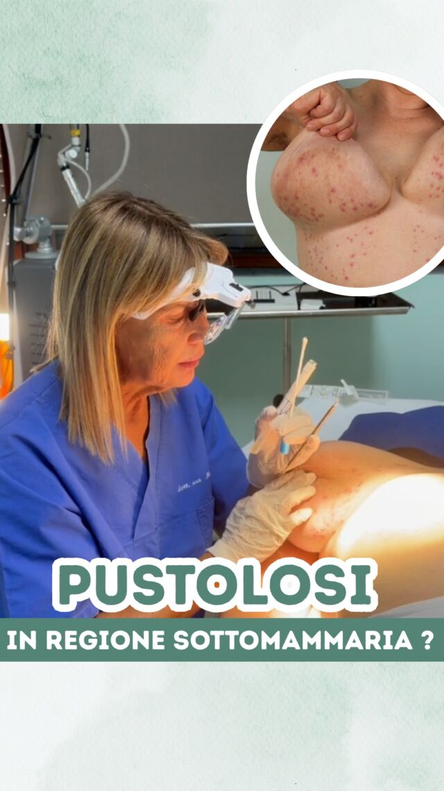 L'altro giorno in Studio è giunta una paziente con una particolare manifestazione cutanea: una PUSTOLOSI in regione sottomammaria🔎

Nel reel vi spiego meglio tutto ...🤔

📍Via Raffaele De Cesare 15, Bari
📱 𝟥𝟩𝟨 𝟣𝟣𝟧𝟣𝟪𝟤𝟨 (acne) / 𝟥𝟦𝟪 𝟨𝟣𝟢𝟥𝟦𝟨𝟣
☎️ 𝟢𝟪𝟢 𝟩𝟫𝟨𝟥𝟥𝟦𝟫

#dottssamarinaconese #dermatologia #casoclinico #new #influencer #bari
