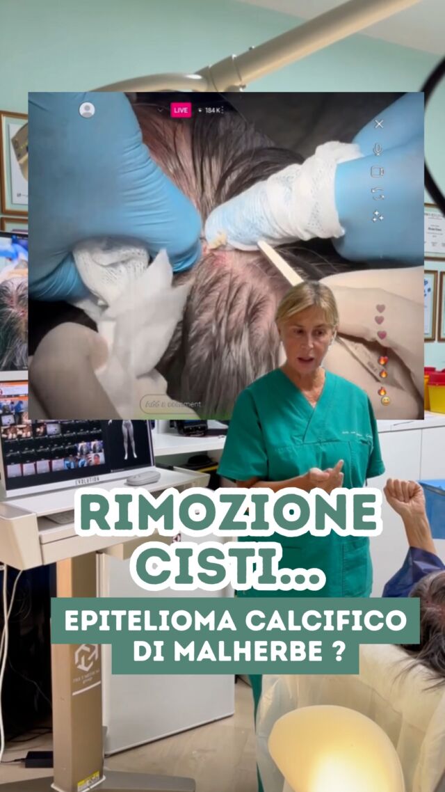 Ultimamente quando ho condiviso con voi alcune RIMOZIONI CISTI, ci sono stati diversi casi in cui si trattava invece di un EPITELIOMA CALCIFICO di MALHERBE.🤔

E QUINDI ? Nel reel vi spiego cosa cambia e se c'è una differenza prognostica tra una CISTI ed un EPITELIOMA CALCIFICO di MALHERBE ...

PROCEDURE TERAPEUTICHE INNOVATIVE PERCORSO ACNE E RIMOZIONE CISTI SEBACEE DOTT.SSA MARINA CONESE™️

📍Via Raffaele De Cesare 15, Bari
📞 𝟥𝟩𝟨 𝟣𝟣𝟧𝟣𝟪𝟤𝟨 (acne) / 𝟥𝟦𝟪 𝟨𝟣𝟢𝟥𝟦𝟨𝟣
☎️ 𝟢𝟪𝟢 𝟩𝟫𝟨𝟥𝟥𝟦𝟫

#dottssamarinaconese #dermatologia #new #cisti #influencer #bari #puglia