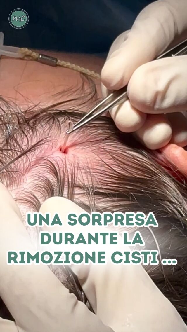 Miei cari followers, l'altro giorno è giunta in Studio una simpatica signora per quella che sembrava essere l’ennesima RIMOZIONE DI UNA CISTI. 
L'avevo attenzionata ecograficamente ed eseguito tutte le procedure di rito.

Durante l'intervento però, è successo qualcosa di piuttosto curioso: dal piccolo forellino non è uscita la capsula, ma qualcosa che non mi era mai capitato di vedere in ben 36 anni di carriera… 👀

PROCEDURE TERAPEUTICHE INNOVATIVE PERCORSO ACNE E RIMOZIONE CISTI SEBACEE DOTT.SSA MARINA CONESE™

📍Via Raffaele De Cesare 15, Bari
📞 𝟥𝟩𝟨 𝟣𝟣𝟧𝟣𝟪𝟤𝟨 (acne) / 𝟥𝟦𝟪 𝟨𝟣𝟢𝟥𝟦𝟨𝟣
☎️ 𝟢𝟪𝟢 𝟩𝟫𝟨𝟥𝟥𝟦𝟫

#dottssamarinaconese #dermatologia #new #cisti #influencer #bari #puglia