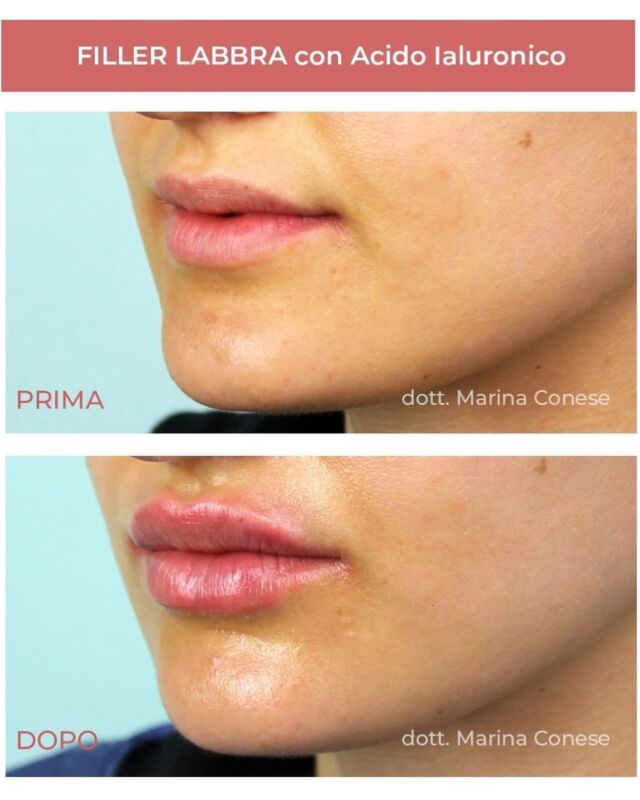 Il filler labbra è un trattamento di medicina estetica che consiste nell’iniezione di acido ialuronico per aumentare il volume, ridefinire i contorni o correggere asimmetrie e rughe periorali (il cosiddetto “codice a barre”).

L’iniezione richiede un’ottima conoscenza dell’anatomia del viso: per questo motivo è fondamentale affidarsi esclusivamente a professionisti formati e qualificati. 

🫵🏻Vuoi saperne di più ? 🫵🏻
📌Sostanza utilizzata: Acido ialuronico (molecola biocompatibile e riassorbibile).
 📌Durata della seduta: circa 30 minuti.
 📌Dolore: Minimo (spesso il gel contiene lidocaina, un anestetico locale, oppure si applica una crema anestetica prima delle iniezioni).
 📌Durata del risultato: Dai 6 ai 12 mesi, a seconda del metabolismo individuale e del tipo di prodotto impiegato.

Per info ℹ️: 0807963349 

#dottssamarinaconese #new #lip #medicinaestetica