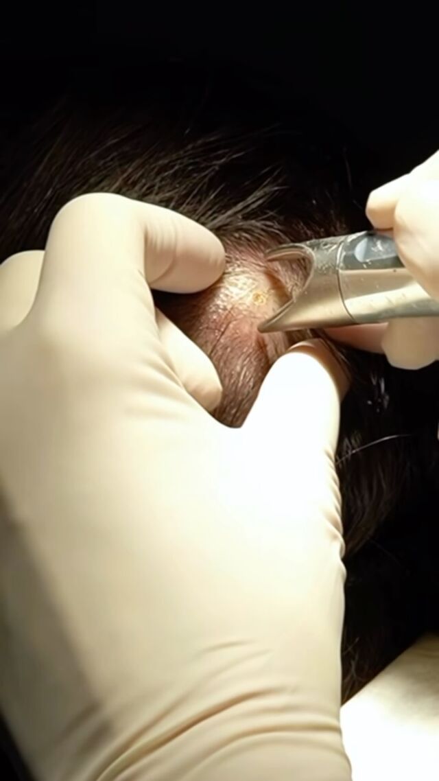 PROCEDURE TERAPEUTICHE INNOVATIVE : PERCORSO ACNE E RIMOZIONE CISTI SEBACEE DOTT.SSA MARINA CONESE™

📍 Via Raffaele De Cesare 15, Bari
📞 𝟥𝟩𝟨 𝟣𝟣𝟧𝟣𝟪𝟤𝟨 (acne) / 𝟥𝟦𝟪 𝟨𝟣𝟢𝟥𝟦𝟨𝟣
☎️ 𝟢𝟪𝟢 𝟩𝟫𝟨𝟥𝟥𝟦𝟫

#dottssamarinaconese #dermatologia #bari #new #cisti