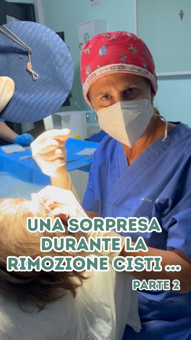 Ed ecco la seconda parte della rimozione "CISTI" ... con sorpresa di ieri. 

Non si trattava ovviamente di una cisti ma di un GRANULOMA DA CORPO ESTRANEO. 

Ebbene si, la signora aveva dei punti di sutura dovuti ad un intervento subito quando era bambina...

PROCEDURE TERAPEUTICHE INNOVATIVE PERCORSO ACNE E RIMOZIONE CISTI SEBACEE DOTT.SSA MARINA CONESE™

📍Via Raffaele De Cesare 15, Bari
📞 𝟥𝟩𝟨 𝟣𝟣𝟧𝟣𝟪𝟤𝟨 (acne) / 𝟥𝟦𝟪 𝟨𝟣𝟢𝟥𝟦𝟨𝟣
☎️ 𝟢𝟪𝟢 𝟩𝟫𝟨𝟥𝟥𝟦𝟫

#dottssamarinaconese #dermatologia #new #cisti #influencer #bari #puglia