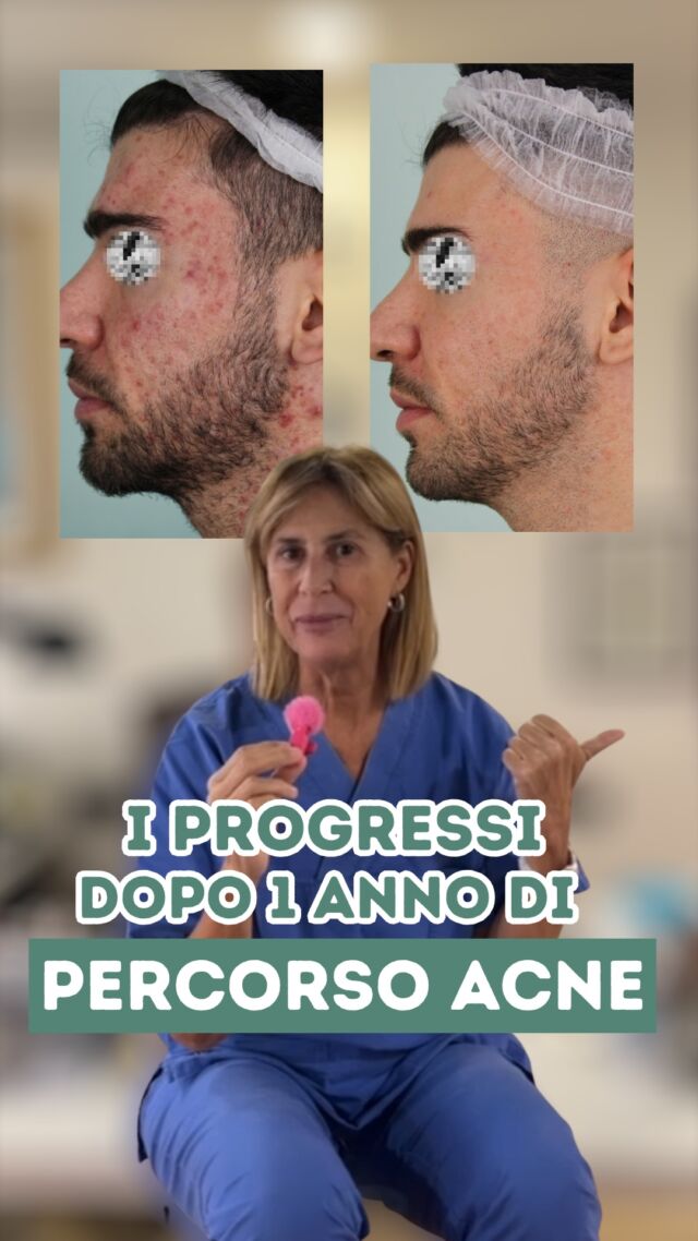 CHE RISULTATI 🤩

Questo ragazzo era giunto nel mio Studio esattamente un anno fa, con una condizione d'acne molto importante...

Abbiamo quindi iniziato insieme il Percorso ACNE che nel suo caso prevedeva costanti sedute di fotobiomodulazione (luce blu), peeling chimici e le creme galeniche personalizzate, scelte in base alle caratteristiche della sua pelle e alla sua problematica.

Dopo esattamente un anno condivido con voi i risultati ottenuti. 
Ah, dimenticavo: SENZA FARMACI ! ❌ 💊

PROCEDURE TERAPEUTICHE INNOVATIVE PERCORSO ACNE E RIMOZIONE CISTI SEBACEE DOTT.SSA MARINA CONESE™️

📍Via Raffaele De Cesare 15, Bari
📞 𝟥𝟩𝟨 𝟣𝟣𝟧𝟣𝟪𝟤𝟨 (acne) / 𝟥𝟦𝟪 𝟨𝟣𝟢𝟥𝟦𝟨𝟣
☎️ 𝟢𝟪𝟢 𝟩𝟫𝟨𝟥𝟥𝟦𝟫

#dottssamarinaconese #dermatologia #acne #influencer #bari #puglia