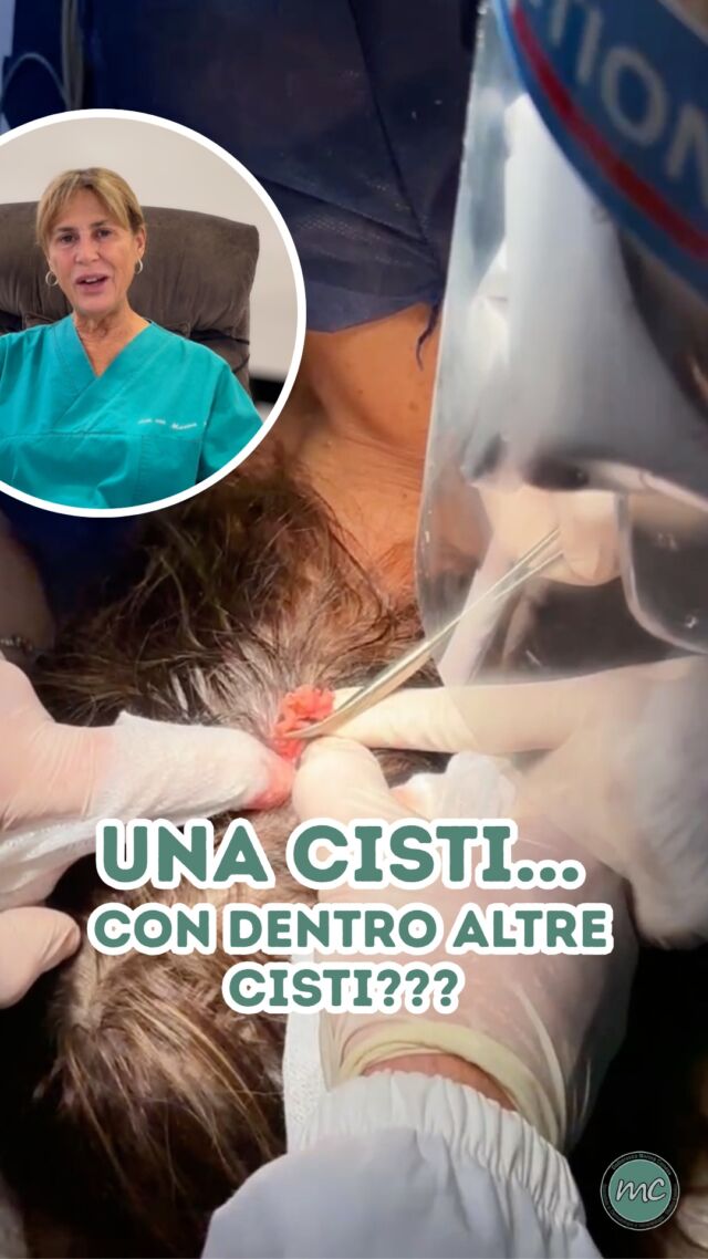 UNA CISTI… CON DENTRO ALTRE CISTI❓

Condivido con voi la seconda rimozione di una cisti sebacea del cuoio capelluto in una mia paziente.

La cosa particolare è che durante la rimozione, parecchio impegnativa, solo dopo aver rimosso la capsula fibrosa abbiamo scoperto l’esistenza di una sorta di “sacco” contenente tante altre piccole cisti!

Questo perché non si trattava di una cisti classica, bensì di uno spiroadenoma eccrino… 👀

PROCEDURE TERAPEUTICHE INNOVATIVE PERCORSO ACNE E RIMOZIONE CISTI SEBACEE DOTT.SSA MARINA CONESE™

📍Via Raffaele De Cesare 15, Bari
📞 𝟥𝟩𝟨 𝟣𝟣𝟧𝟣𝟪𝟤𝟨 (acne) / 𝟥𝟦𝟪 𝟨𝟣𝟢𝟥𝟦𝟨𝟣
☎️ 𝟢𝟪𝟢 𝟩𝟫𝟨𝟥𝟥𝟦𝟫

#dottssamarinaconese #dermatologia #new #cisti #influencer #bari #puglia
