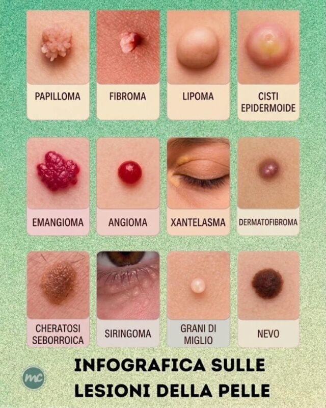 NON TUTTE LE LESIONI CUTANEE SONO UGUALI 🧐

Come potete vedere da questa infografica, 𝐬𝐮𝐥𝐥𝐚 𝐩𝐞𝐥𝐥𝐞 𝐩𝐨𝐬𝐬𝐨𝐧𝐨 𝐜𝐨𝐦𝐩𝐚𝐫𝐢𝐫𝐞 𝐝𝐢𝐯𝐞𝐫𝐬𝐞 𝐭𝐢𝐩𝐨𝐥𝐨𝐠𝐢𝐞 𝐝𝐢 𝐥𝐞𝐬𝐢𝐨𝐧𝐢, ognuna con caratteristiche specifiche:

- i papillomi ed i fibromi cioè delle piccole formazioni cutanee generalmente benigne, spesso morbide e rilevate rispetto alla superficie della pelle
- i lipomi e le cisti epidermoidi, delle formazioni sottocutanee che possono presentarsi come noduli di consistenza variabile
- gli emangiomi e gli angiomi, delle lesioni di origine vascolare generalmente caratterizzate da una colorazione rossastra
- gli xantelasmi, dei depositi giallastri che compaiono più frequentemente nella zona delle palpebre
- i dermatofibromi, dei piccoli noduli cutanei benigni spesso duri al tatto e localizzati soprattutto agli arti
- le cheratosi seborroiche, che sono delle lesioni benigne dalla superficie ruvida 
- i siringomi, piccole papule che compaiono frequentemente nella zona perioculare
- i grani di miglio, piccole cisti superficiali di cheratina molto comuni soprattutto sul viso
- infine i nevi, lesioni pigmentate molto comuni che possono presentarsi con forme e colorazioni differenti, da tenere d'occhio grazie a mappature complete ed approfondite…

L'obiettivo di noi Dermatologi è quello di 𝐯𝐚𝐥𝐮𝐭𝐚𝐫𝐞 𝐨𝐠𝐧𝐢 𝐥𝐞𝐬𝐢𝐨𝐧𝐞 𝐧𝐞𝐥𝐥𝐚 𝐬𝐮𝐚 𝐬𝐩𝐞𝐜𝐢𝐟𝐢𝐜𝐢𝐭𝐚̀', 𝐫𝐢𝐜𝐨𝐧𝐨𝐬𝐜𝐞𝐫𝐧𝐞 𝐥𝐞 𝐜𝐚𝐫𝐚𝐭𝐭𝐞𝐫𝐢𝐬𝐭𝐢𝐜𝐡𝐞 𝐞 𝐢𝐧𝐝𝐢𝐯𝐢𝐝𝐮𝐚𝐧𝐝𝐨, quando necessario, 𝐢𝐥 𝐩𝐞𝐫𝐜𝐨𝐫𝐬𝐨 𝐝𝐢𝐚𝐠𝐧𝐨𝐬𝐭𝐢𝐜𝐨 𝐞 𝐭𝐞𝐫𝐚𝐩𝐞𝐮𝐭𝐢𝐜𝐨 𝐩𝐢𝐮̀ 𝐚𝐝𝐚𝐭𝐭𝐨 𝐚𝐥𝐥𝐞 𝐞𝐬𝐢𝐠𝐞𝐧𝐳𝐞 𝐝𝐞𝐥 𝐩𝐚𝐳𝐢𝐞𝐧𝐭𝐞, compresa l'eventuale rimozione della lesione stessa. 👩‍⚕️

📍Via Raffaele De Cesare 15, Bari
📞 𝟥𝟩𝟨 𝟣𝟣𝟧𝟣𝟪𝟤𝟨 (acne) / 𝟥𝟦𝟪 𝟨𝟣𝟢𝟥𝟦𝟨𝟣
☎️ 𝟢𝟪𝟢 𝟩𝟫𝟨𝟥𝟥𝟦𝟫

#dottssamarinaconese #dermatologia #new #skin #bari #puglia #influencer