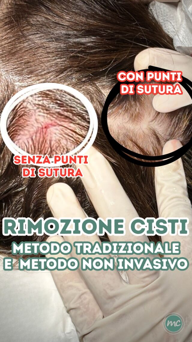 METODO TRADIZIONALE vs CHIRURGIA MINIMAMENTE INVASIVA 👩‍⚕️

Mentre rimuovevo l’ennesima CISTI, ho notato che la paziente ne aveva già rimossa un'altra in passato, però con il METODO TRADIZIONALE (ovvero con il taglio dei capelli e la successiva applicazione dei punti di sutura). ✂️🪡

Vi mostro come a distanza di mesi (anzi di anni !) sia ancora presente una sorta di alopecia cicatriziale nella zona interessata...
Con il mio metodo invece, la CHIRURGIA MINIMAMENTE INVASIVA, non ci sono né taglio dei capelli né i punti di sutura. 

Il piccolo "forellino" da cui faccio fuoriuscire la capsula della CISTI si chiuderà in poco tempo per seconda intenzione: il recupero è più rapido e il danno estetico inesistente. ❌✂️🪡 

E i capelli ricresceranno ! 

PROCEDURE TERAPEUTICHE INNOVATIVE PERCORSO ACNE E RIMOZIONE CISTI SEBACEE DOTT.SSA MARINA CONESE™

📍Via Raffaele De Cesare 15, Bari
📞 𝟥𝟩𝟨 𝟣𝟣𝟧𝟣𝟪𝟤𝟨 (acne) / 𝟥𝟦𝟪 𝟨𝟣𝟢𝟥𝟦𝟨𝟣
☎️ 𝟢𝟪𝟢 𝟩𝟫𝟨𝟥𝟥𝟦𝟫

#dottssamarinaconese #dermatologia #cisti #bari #influencer #new