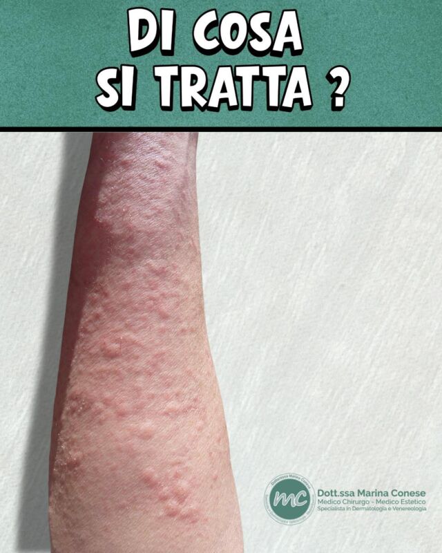CASO CLINICO ⚠️

Prurito intenso, chiazze rosse e/o infiammate, a volte compaiono anche delle piccole vescicole... 
La pelle può impiegare giorni o settimane per tornare alla normalità: DI COSA SI TRATTA❓🤔

Scrivete la vostra ipotesi nei commenti ! Nei prossimi giorni vi svelo la diagnosi... 👇👀

📍Via Raffaele De Cesare 15, Bari
📞 𝟥𝟩𝟨 𝟣𝟣𝟧𝟣𝟪𝟤𝟨 (acne) / 𝟥𝟦𝟪 𝟨𝟣𝟢𝟥𝟦𝟨𝟣
☎️ 𝟢𝟪𝟢 𝟩𝟫𝟨𝟥𝟥𝟦𝟫

#dottssamarinaconese #dermatologia #new #pelle #influencer #bari #puglia
