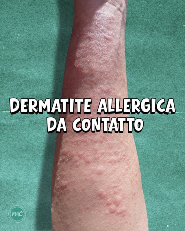 DIAGNOSI CASO CLINICO : DERMATITE ALLERGICA DA CONTATTO 🔎

La DERMATITE ALLERGICA DA CONTATTO (DAC) è una reazione eczematosa della pelle causata dal contatto con una sostanza verso cui il sistema immunitario si è sensibilizzato. 
Si tratta di una reazione immunologica che richiede una fase di sensibilizzazione precedente, anche se questa può essere passata inosservata. 

Non va confusa con la DERMATITE IRRITITATIVA DA CONTATTO, che ha un meccanismo diverso. 

COME SI MANIFESTA❓
Con prurito intenso, arrossamento, gonfiore e piccole vescicole. Nei casi più persistenti possono comparire desquamazione e fissurazioni.
Tra i possibili responsabili troviamo nichel e altri metalli, profumi, cosmetici, conservanti, gomma o anche farmaci topici. 

La reazione può comparire a distanza di ore o giorni dal contatto e la pelle può impiegare giorni o settimane per tornare alla normalità. 
Per individuare la causa è importante valutare anche l'ambiente domestico, le abitudini personali e le attività lavorative del paziente.

COSA FARE❓
È fondamentale individuare ed evitare l'allergene responsabile. Il dermatologo può ricostruire la storia delle esposizioni del paziente e quando indicato prescrivere i patch test (test epicutanei), che permettono così di identificare eventuali allergie da contatto.

In base alla gravità, può poi indicare una terapia specifica da attuare. 💪🏻

📍Via Raffaele De Cesare 15, Bari
📞 𝟥𝟩𝟨 𝟣𝟣𝟧𝟣𝟪𝟤𝟨 (acne) / 𝟥𝟦𝟪 𝟨𝟣𝟢𝟥𝟦𝟨𝟣
☎️ 𝟢𝟪𝟢 𝟩𝟫𝟨𝟥𝟥𝟦𝟫

#dottssamarinaconese #dermatologia #new #pelle #influencer #bari #puglia