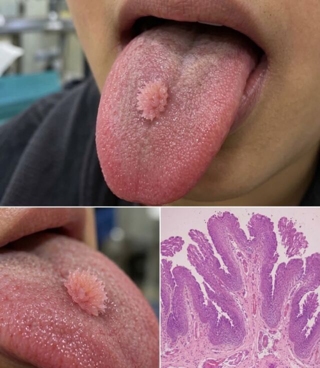 ⛔️ Da evitare assolutamente i fai da te l’autodiagnosi e l’automedicazione ⛔️. 

Da sempre mi sono occupata di malattie del cavo orale, frequentando sin da appena laureata lo studio medico dentistico di mio zio. La dermatologia ( per chi non lo sapesse ) include anche la diagnosi e terapia delle malattie del cavo orale. 
Vi mostro questo caso clinico completo di esame  istologico di un paziente di 24  che presenta una lesione papillare rosa, “ a cavolfiore “ solitaria e indolore e a crescita lenta sulla regione dorsale della lingua. 
La mucosa circostante appare intatta, senza ulcerazioni o sanguinamenti spontanei.
Ovviamente si procede alla biopsia escissionale con relativo esame istologico . 
L’esame istopatologico evidenzia lesioni papillari ramificate fibrovascolari rivestite da epitelio squamoso maturo stratificato. 

Diagnosi: Papilloma squamoso orale. 

Il papilloma squamoso della lingua è una lesione benigna del cavo orale, il più delle volte correlata a ceppi di HPV a basso rischio.

Trattamento risolutivo:la sua asportazione chirurgica .

Qualsiasi lesione dubbia rivolgetevi sempre al vostro medico/dermatologo di fiducia in modo da non ritardare la diagnosi e le cure del caso. 

⛔️ Da evitare assolutamente i fai da te l’autodiagnosi e l’automedicazione ⛔️. 

#dottssamarinaconese #news