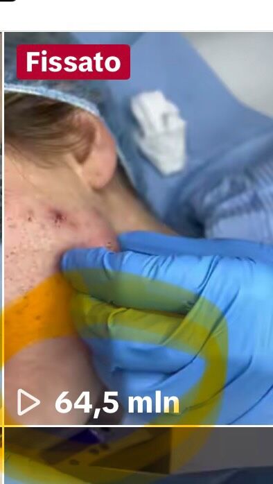 Asportazione di cisti sebacea sul volto esattamente in regione mandibolare. 

Era il 2022. Allora utilizzavo un altro medical device per la mia chirurgia minimamente invasiva. 

Questo video che vi sto riproponendo oggi non so 🤷‍♀️ perché schizzo‘ 💦 in tutti i sensi ( come vedrete nel Reel) e mi fece raggiungere quasi 65 MILIONI di visualizzazioni…. 
E non solo … ( a proposito poi ovviamente ho tolto anche la capsula della cisti ‼️ ). 

#dottssamarinaconese #dermatologia #new