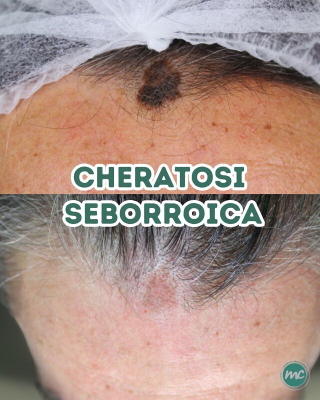 Buon lunedì a tutti ! 🔆

Condivido con voi il PRIMA ed il risultato immediatamente DOPO la RIMOZIONE di una CHERATOSI SEBORROICA in regione frontale eseguita da me questa mattina (dopo averla ovviamente esaminata dermatoscopicamente).

DI COSA SI TRATTA ❓
Le CHERATOSI SEBORROICHE sono delle lesioni cutanee benigne molto comuni negli adulti, soprattutto dopo i 40-50 anni. 

Si presentano come formazioni rilevate sulla superficie della pelle, con una colorazione variabile dal marrone chiaro al marrone scuro e una superficie talvolta ruvida o verrucosa.

COME L'HO RIMOSSA ❓
Mediante Laser CO2 a wattaggi e potenze molto basse, per trattare la lesione in modo mirato e preciso, riducendo così al minimo il disagio per il paziente e con la sicurezza di un risultato perfetto, senza esiti cicatriziali o discromici. 💪

Nel corso delle prossime settimane vi aggiornerò sull’evoluzione della zona trattata, mostrandovi i progressi ottenuti nel tempo...

📍Via Raffaele De Cesare 15, Bari
📱 𝟥𝟩𝟨 𝟣𝟣𝟧𝟣𝟪𝟤𝟨 (acne) / 𝟥𝟦𝟪 𝟨𝟣𝟢𝟥𝟦𝟨𝟣
☎️ 𝟢𝟪𝟢 𝟩𝟫𝟨𝟥𝟥𝟦𝟫

#dottssamarinaconese #dermatologia #cheratosi #influencer #bari #puglia #new
